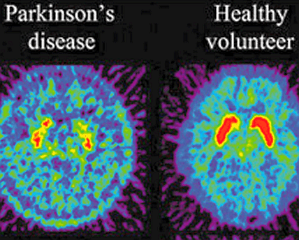 Parkinson’s diagnosis [Is a DAT scan/ F-DOPA PET scan needed?]