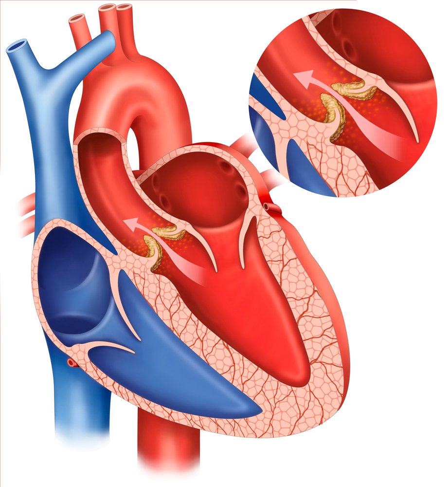 What Is Syncope Orthostatic Hypotension 