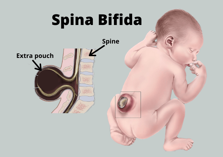 Spina Bifida e1621022543818