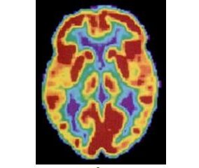 Scans depicting CT PET and fMRI brain scans e1621254912562