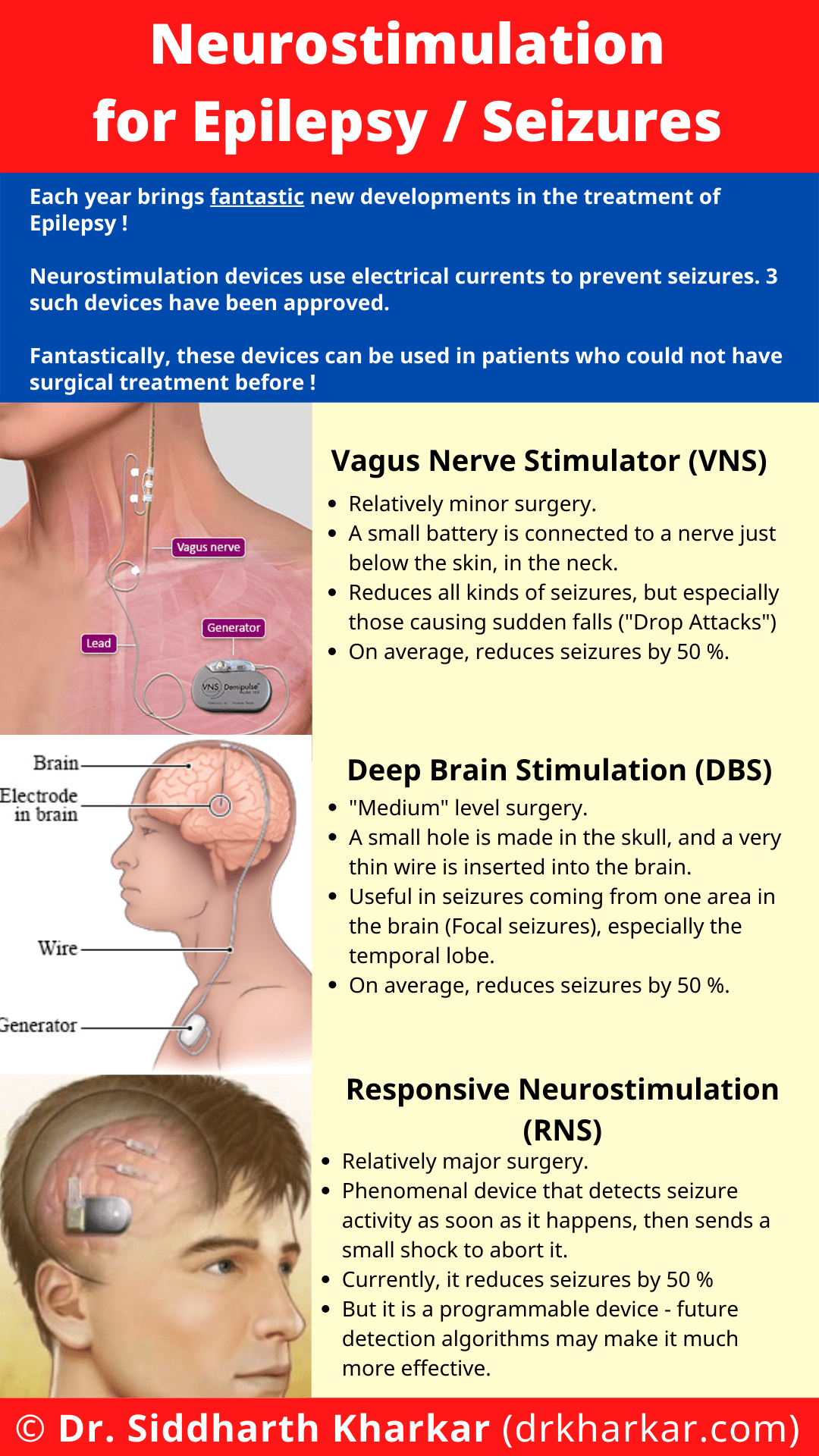 Neuromodulation / Neurostimulation For Epilepsy