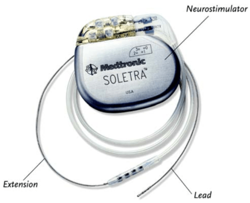 DBS device used for the treatment of parkinsons disease