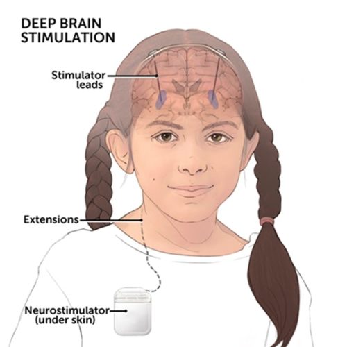 Deep brain stimulation DBS is a surgery for Parkinsons disease