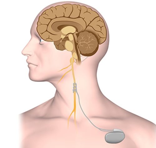 Vagus Nerve stimulation for epilepsy seizures
