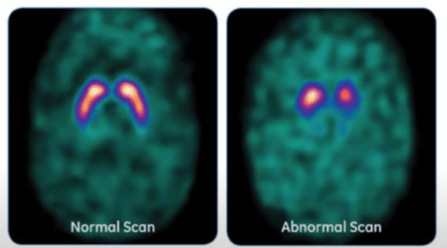 fDOPA scan can confirm the diagnosis of parkinsons disease