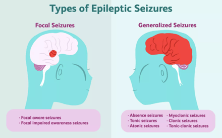Types of seizures e1667058332731