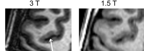 A 3T MRI using special techniques can detect very small abnormal areas. These areas may not be visible on low resolution MRIs.