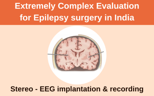 Epilepsy surgery cost in India is high when stereo-EEG needs to be done.