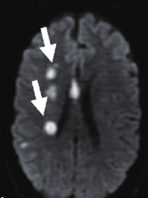If the brain MRI shows multiple abnormal areas, then we need further tests to find which one to take out.