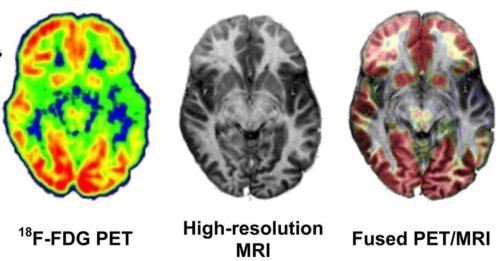 PET-MRI fusion is a new evaluation technique for Epilepsy surgery.