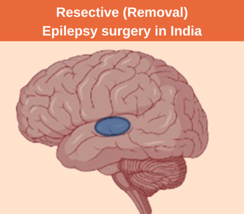 Resective (removal) Epilepsy surgery is one of the cheapest epilespy surgeries in India.