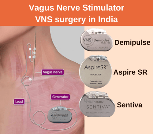 VNS Epilepsy surgery cost in India depends on the type of VNS device that is used.