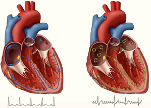 cardiac arrythmias epilepsy misdiagnosis