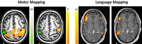 Functional MRI helps us to find brain areas controlling lanauge and limb movement.
